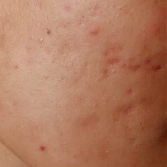 Uneven texture & Acne scars