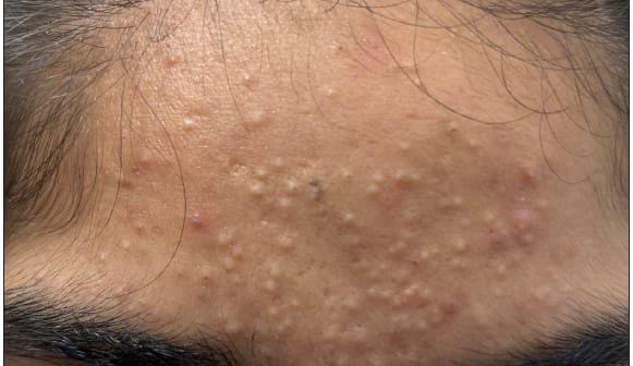 Acne and breakouts